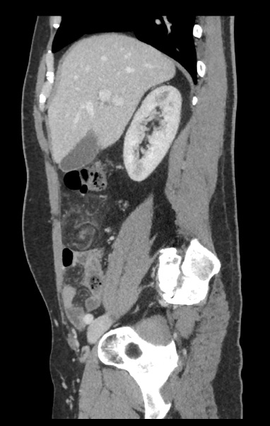 jftrebolle's tweet photo. Curioso caso de abdomen agudo secundario a infarto de epiplon por torsión del mismo. Magnífico diagnóstico radiológico @A_Rodrgz_B https://t.co/wMd81Wh5SD