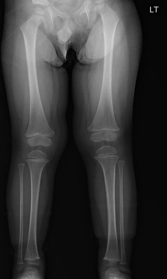jan_gebbertMD's tweet photo. In Orthopedics, we can rarely say "I helped to save someone "life"". This child came with Length discrepancy. I told the mother that she needs to do abd ultrasound. She come for one year FU and I ask her if she did, she said they did and found Wilm's tumor https://t.co/TCQ6kx74QO