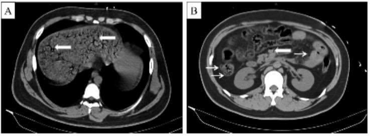 john_damianosMD's tweet photo. Man dies after drinking 1.5 L of Coca Cola causing gas to infiltrate the gut and biliary system. 🥤 

#medtwitter #medicine #GITwitter 

https://t.co/lyjbMrGyIr https://t.co/hGjyKRp1In