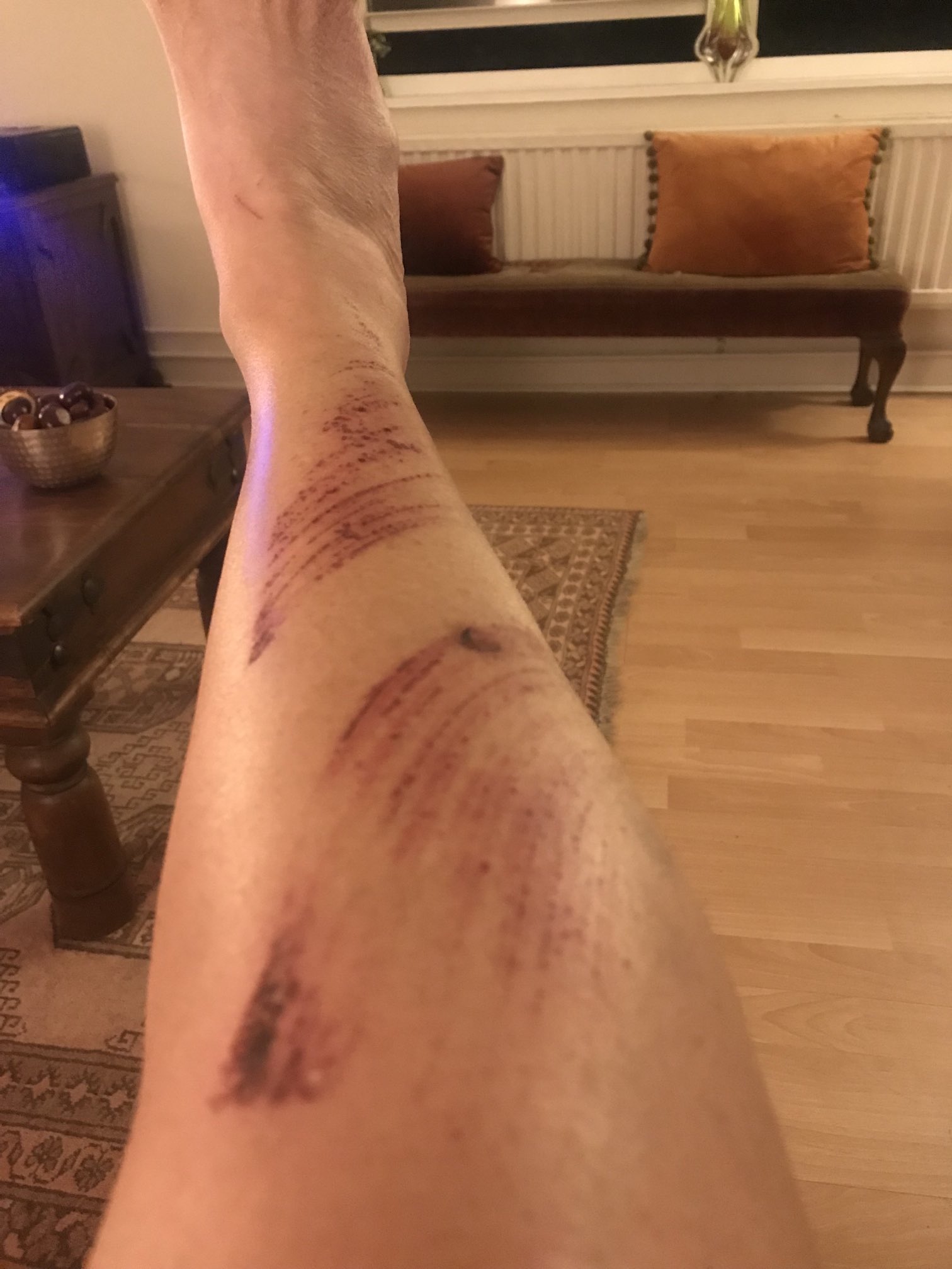 Louise Painedavey on X: Leg update. So sore. Bruise on back is