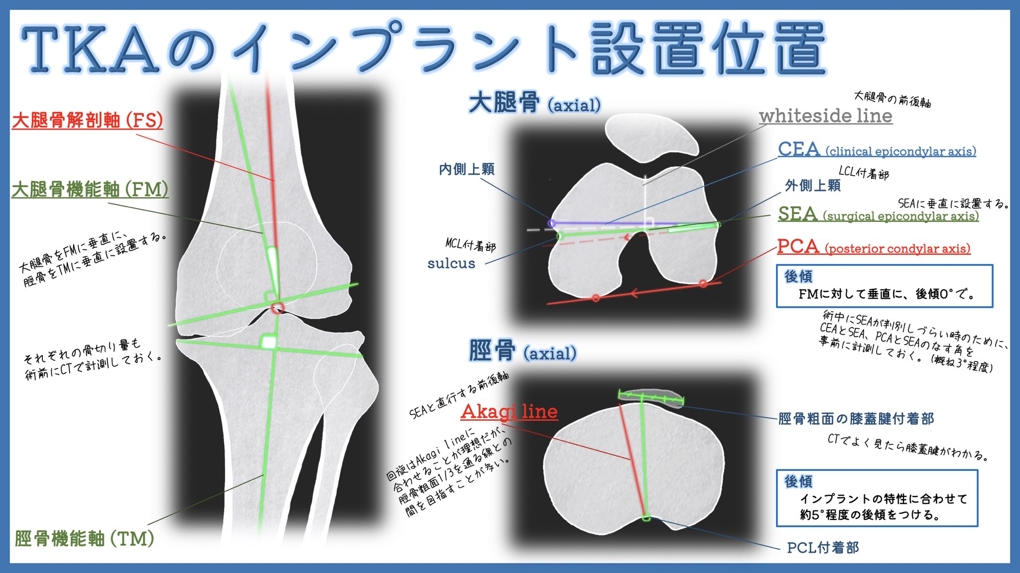 ユジカワ 整形dr イラストレーター 再投稿 変形性膝関節症まとめです Tkaや外反母趾の手術は シンプルに曲がっているものが真っ直ぐになる喜びがある 新作は10 4再開予定 変形性膝関節症 Tka イラスト日記 T Co Wkcw3xllsi Twitter