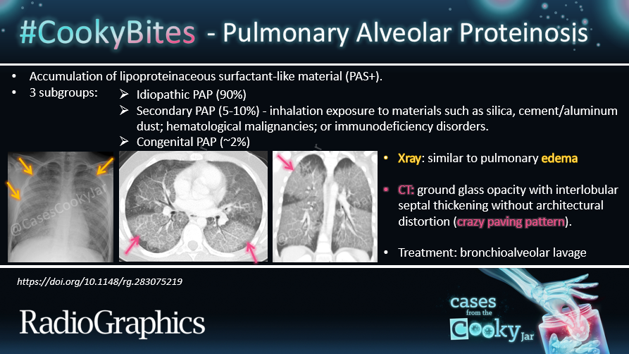 Alveolar Proteinosis Radiopaedia