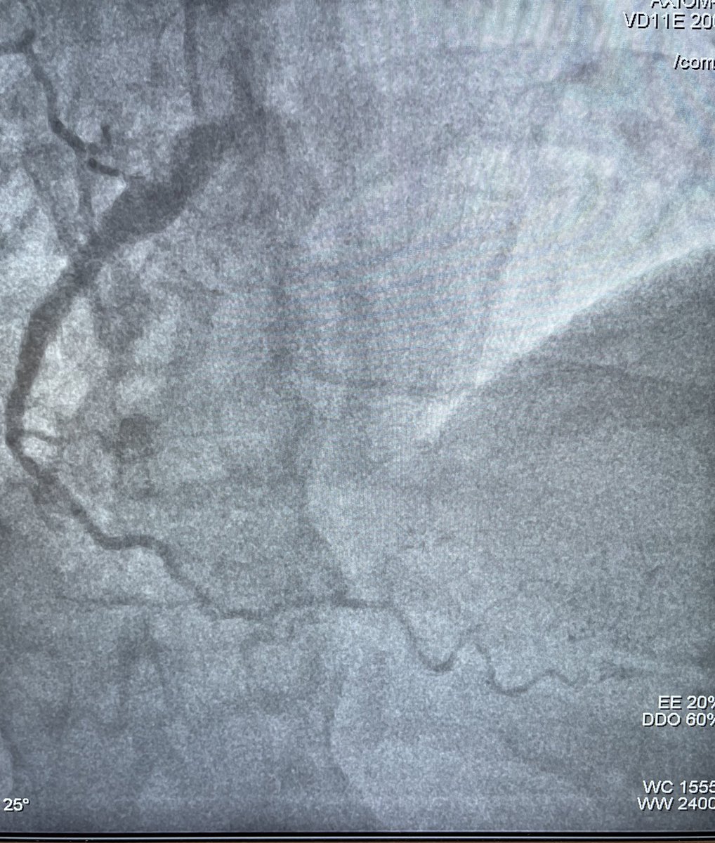 markiewicz_md's tweet photo. Incredible @AvailMedsystems case. If the great dr Sean Janzer is not at your institution for a cto of rca then bring him there virtually with avail live broadcast. North platte to Philadelphia zero seconds. Thanks @JanzerSean.  Will transform med and med ed https://t.co/JskpcNggBJ