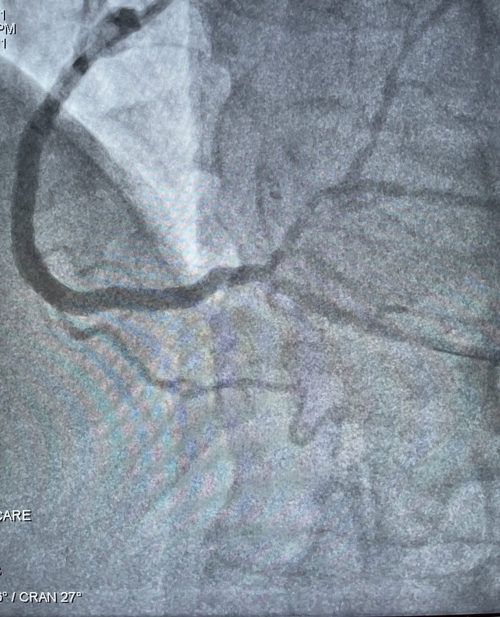 markiewicz_md's tweet photo. Incredible @AvailMedsystems case. If the great dr Sean Janzer is not at your institution for a cto of rca then bring him there virtually with avail live broadcast. North platte to Philadelphia zero seconds. Thanks @JanzerSean.  Will transform med and med ed https://t.co/JskpcNggBJ