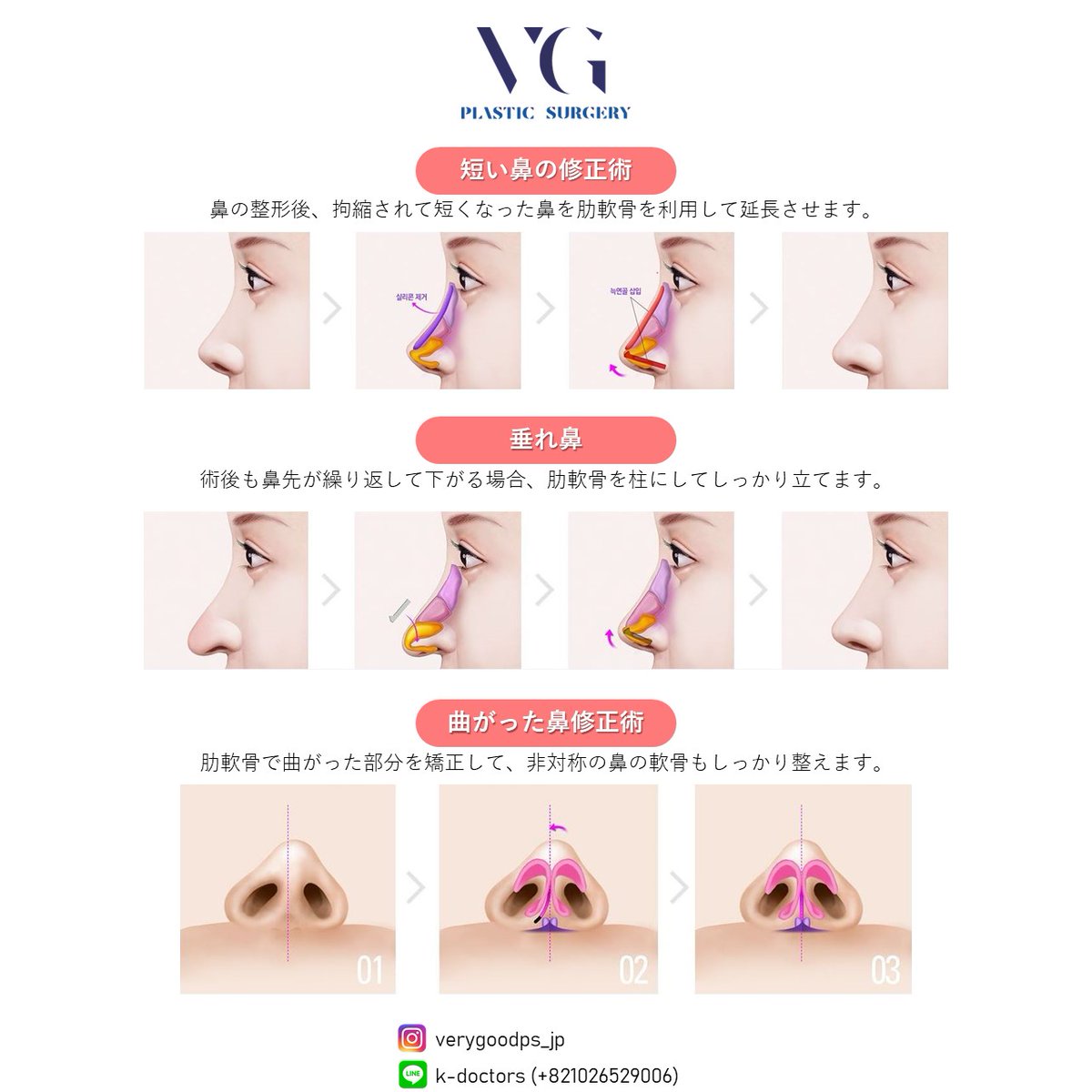 verygoodps_jp's tweet photo. 安全な材料で自然な鼻完成！
#鼻形成 #鼻先形成 #鼻プロテーゼ https://t.co/SSw6PvOu7r