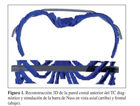 DrBernardoNunez's tweet photo. En Cirugía Pediátrica de @parctauli desde hace casi 2 años, empleamos prótesis 3D diseñadas a medida en #PextusExcavatum.
Junto al grupo de Martinez-Ferro y Gastón Bellia en Argentina, @taulicirped es pionero en el uso de la Impresión 3D en Pectus.
#SoMe4PedSurg https://t.co/w3WnFwMuru