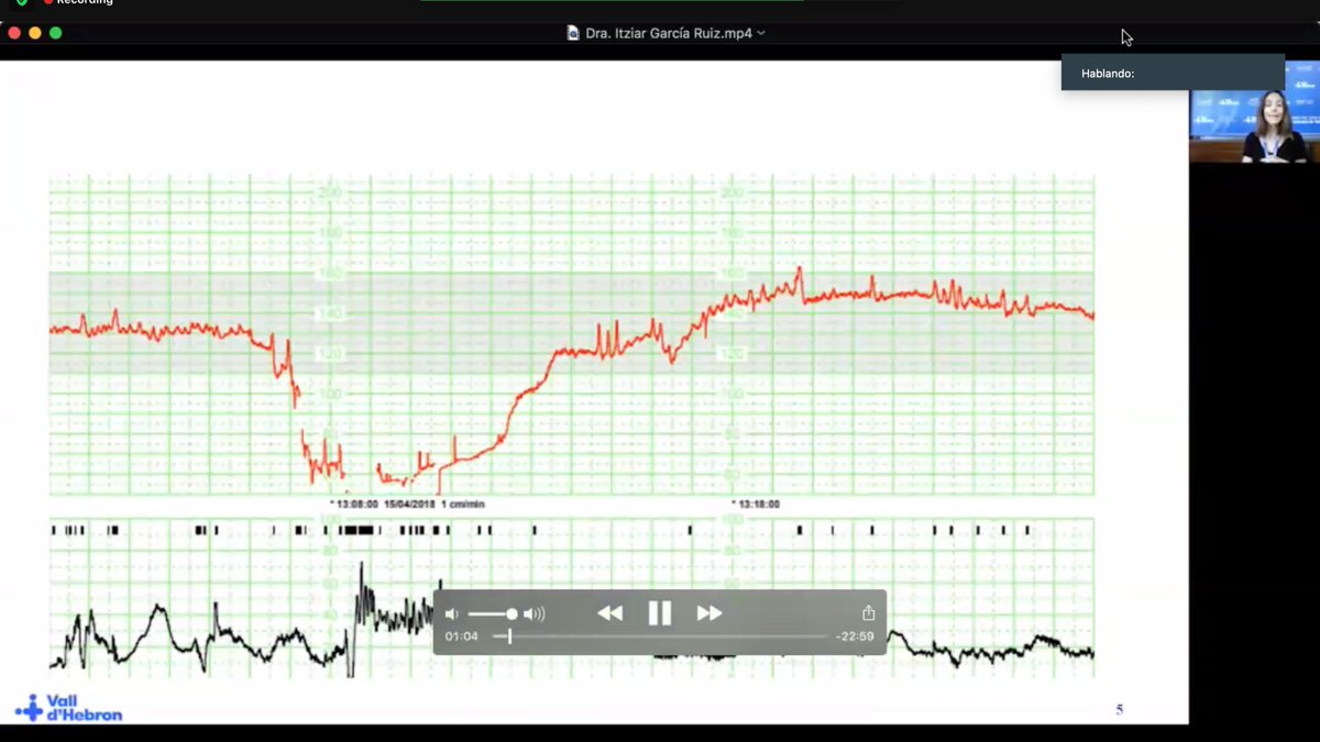 Avui comença el "Curs de reinterpretació del registre cardiotocogràfic" organitzat pel Servei d'#ObstetríciaVH. Més de 1.000 assistents descobriran com poden controlar el grau de benestar fetal intrapart d'una manera segura i menys invasiva amb aquesta tècnica. #AulaVH