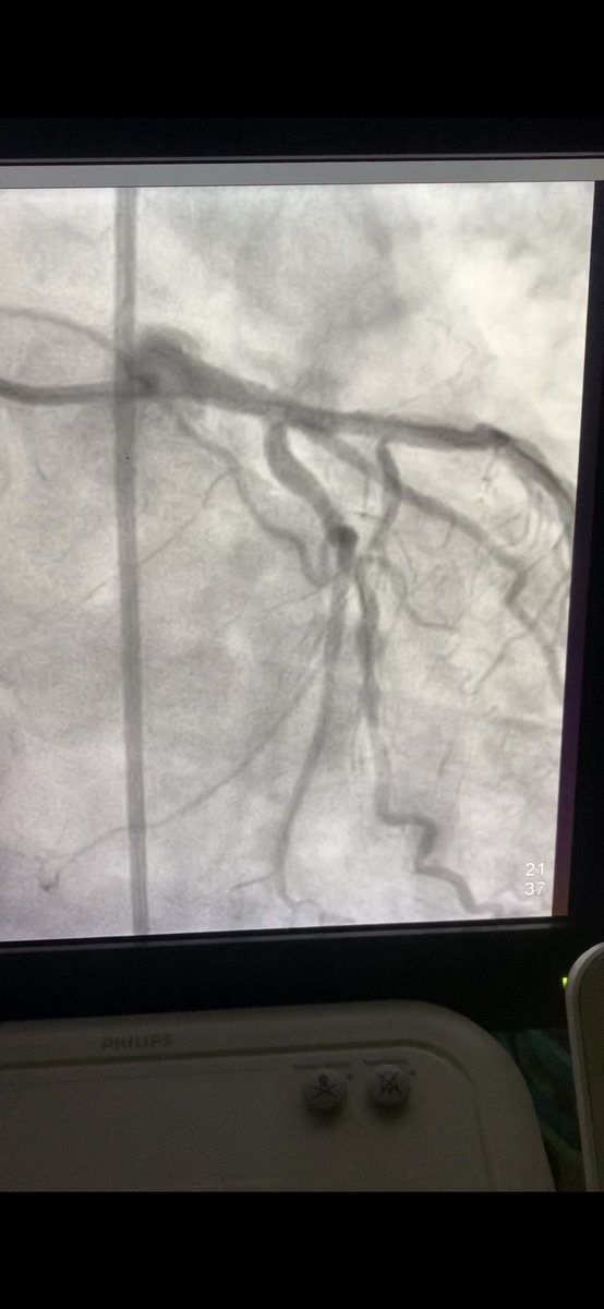 Cerrahpasa cardiology (@cerrahpasac) on Twitter photo pPCI of an ostial LAD lesion in anterior STEMI. Following predilatation of infarct-related lesion, 3.5x34 mm DES implanted through LMCA to LAD at nominal pressure. POT performed using 4.5x8 mm NC baloon at LMCA. Operator: Orhan Furkan Karaca #anteriorstemi #pci <a href="/iu_cerrahpasa/">İstanbul Üniversitesi-Cerrahpaşa - #eniyiolmakiçin</a> pPCI of an ostial LAD lesion in anterior STEMI. Following predilatation of infarct-related lesion, 3.5x34 mm DES implanted through LMCA to LAD at nominal pressure. POT performed using 4.5x8 mm NC baloon at LMCA. Operator: Orhan Furkan Karaca #anteriorstemi #pci <a href="/iu_cerrahpasa/">İstanbul Üniversitesi-Cerrahpaşa - #eniyiolmakiçin</a>
