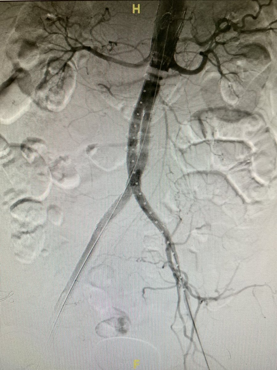 ReVascMed (@revascmed) on Twitter photo Successful fully percutaneous #EVAR for a 5.5 cm infra-renal abdominal aneurysm #AAA with mural thrombus through severely diseased iliac arteries. <a href="/GPAngioClub/">Phila Angio Club</a> <a href="/ACVCPhila/">Academy for CardioVascular Collaboration</a> <a href="/jcgeorgemd/">Jon George</a> <a href="/endologix/">Endologix</a> <a href="/PennCardiology/">Penn Cardiology</a> <a href="/PennCVFellows/">Penn Cardiology Fellows</a> Successful fully percutaneous #EVAR for a 5.5 cm infra-renal abdominal aneurysm #AAA with mural thrombus through severely diseased iliac arteries. <a href="/GPAngioClub/">Phila Angio Club</a> <a href="/ACVCPhila/">Academy for CardioVascular Collaboration</a> <a href="/jcgeorgemd/">Jon George</a> <a href="/endologix/">Endologix</a> <a href="/PennCardiology/">Penn Cardiology</a> <a href="/PennCVFellows/">Penn Cardiology Fellows</a>