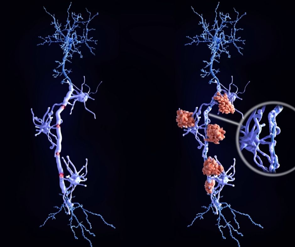 speakersnetwork's tweet photo. Approx. 2.8 million people are affected by Multiple Sclerosis (MS) worldwide, with the prevalence increasing since 2013. Because symptoms can be completely invisible, most MS ...view lecture summary to read more https://t.co/AlI5NJcQw7  #speakersnetwork #medicaleducation #cme https://t.co/LZZkdQOeEQ