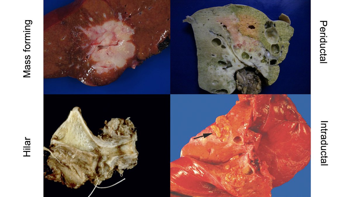 Join Dr. Dhanpat Jain & @zhang_xuchen for a case-based discussion on liver mass lesions, with an emphasis in differential diagnosis and pitfalls at #CAP21 today at 3pmCDT. @Pathologists @YaleMed @YaleCancer @YaleGICancers @YaleLiverCancer capannualmeeting.org/agenda/?agenda…