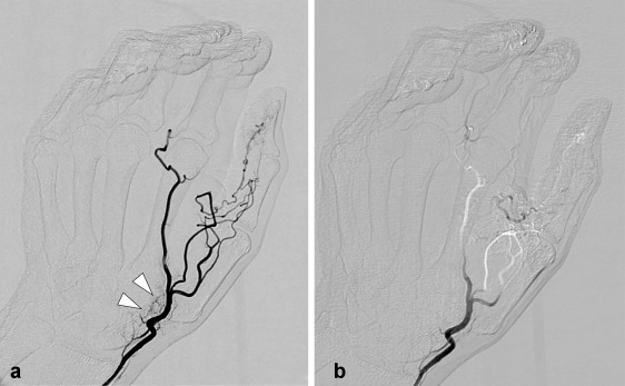 JVIR (@jvirmedia) on Twitter photo Intra-Arterial Infusion of Imipenem/Cilastatin Sodium through a Needle Inserted into the Radial Artery as a New Treatment for Refractory Trapeziometacarpal Osteoarthritis. ow.ly/XjZc50G9l7q #irad <a href="/OkunoYuji/">Yuji Okuno Ph.D. (å„„éē„ꬔ)</a> Intra-Arterial Infusion of Imipenem/Cilastatin Sodium through a Needle Inserted into the Radial Artery as a New Treatment for Refractory Trapeziometacarpal Osteoarthritis. ow.ly/XjZc50G9l7q #irad <a href="/OkunoYuji/">Yuji Okuno Ph.D. (å„„éē„ꬔ)</a>