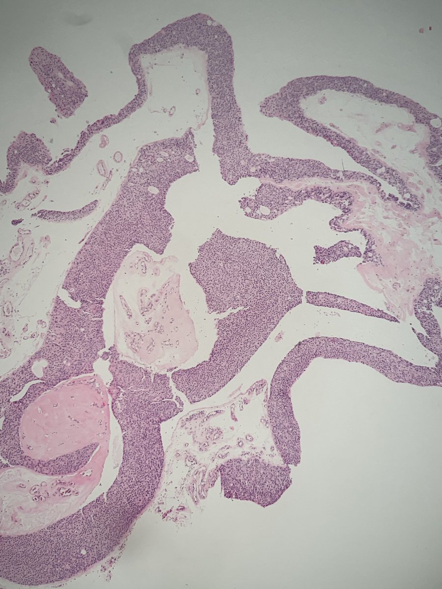 Cutaneous cystic lesion from waist area of 47 y/o man, any suggestions?