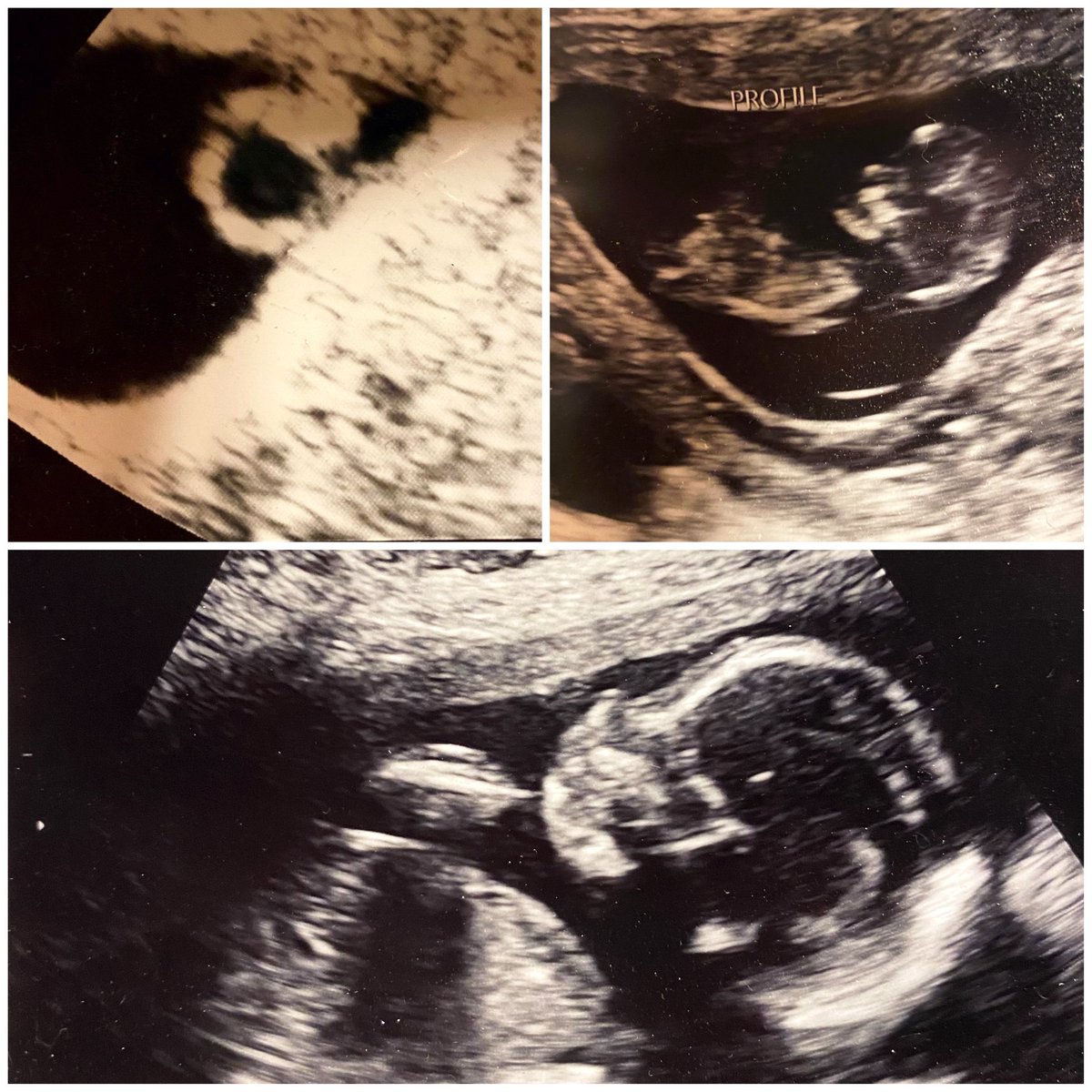 SuperMommy2_'s tweet photo. From a diamond ring to a healthy, growing boy!! Life is incredible and we are blessed. We are almost 14 weeks away from meeting our little sweet pea! We love you π This journey has been so amazing with you @GorillaPattilla π₯° #LifeStages #LandryWilson #GrowingFast https://t.co/zYKNlqqOjO