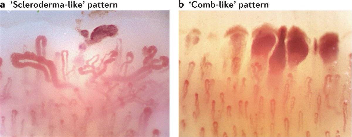 NatRevRheumatol's tweet photo. Online now! Maurizio Cutolo &amp; Vanessa Smith discuss the detection of microvascular changes in #SystemicSclerosis and other rheumatic diseases in our new #Review. 

https://t.co/giYSsDv9EH

#RheumTwitter #rheumatology https://t.co/eXEAD77rE5
