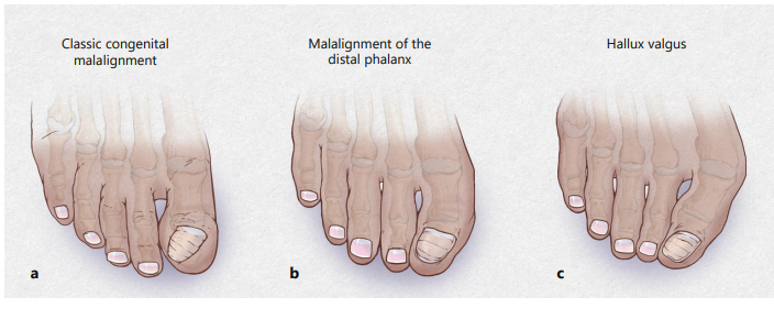 DermaKarger's tweet photo. Have a look at our #OpenAccess review on Congenital Malalignment of the Great Toenail, the Disappearing Nail Bed, and Distal Phalanx Deviation. 🦶
🔗https://t.co/qpLASvK608
✍️Benjamin Buttars et al.
--
#CongenitalMalalignment #toenail #Microtrauma #nails https://t.co/LdIvnEFSnm