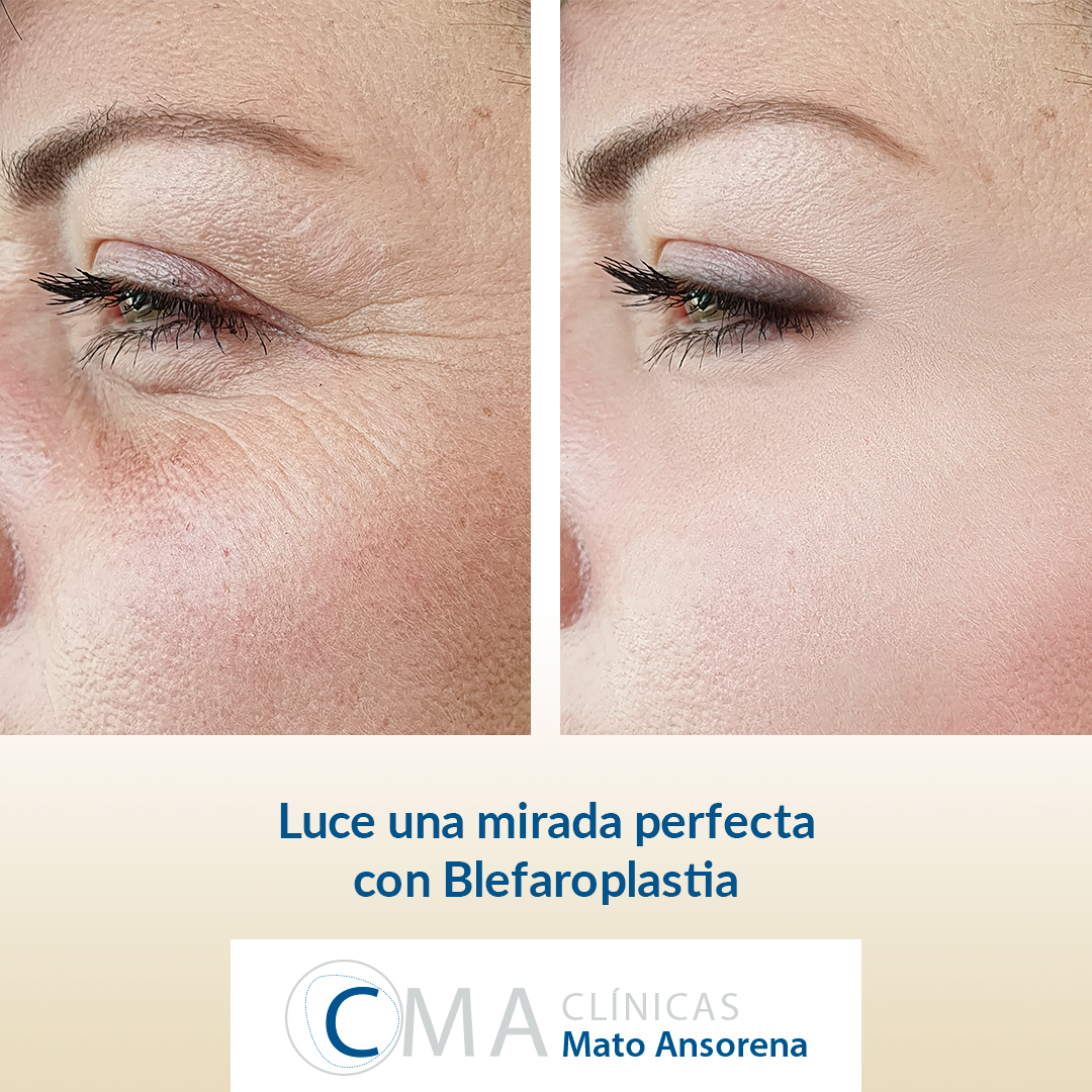 mato_ansorena's tweet photo. La blefaroplastia es uno de los retoques estéticos más demandados para poder lucir una mirada joven y fresca, sin bolsas ni párpados caídos...
En CMA somos expertos en realizar esta  intervención rápida, cómoda y ambulatoria.
Mad 915626505 Sev 955223633
https://t.co/y9pD7epyKA https://t.co/vg75Frj7xB
