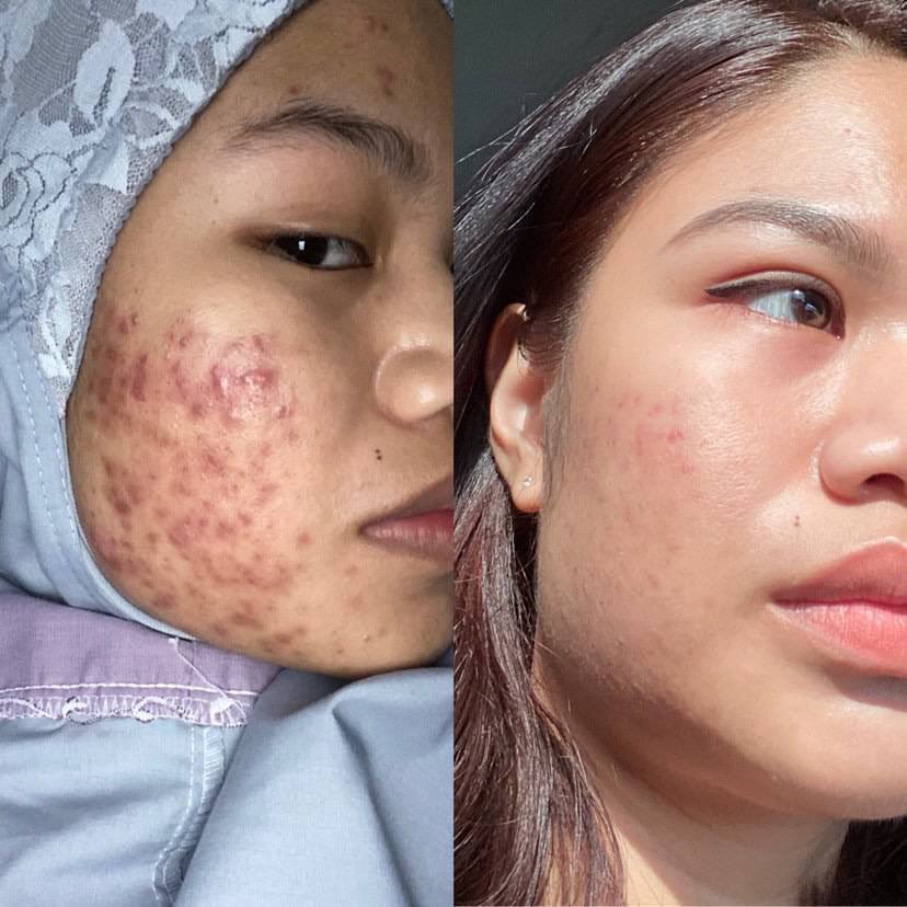 faveblush's tweet photo. She only use 1 bottle of BHS and RSS 😳🤯 sumpah mind blown🥵 but you know nothing is impossible!! and alhamdulillah skin dia dah makin baik!! 

before:                      after: https://t.co/9tB0BGBjVB