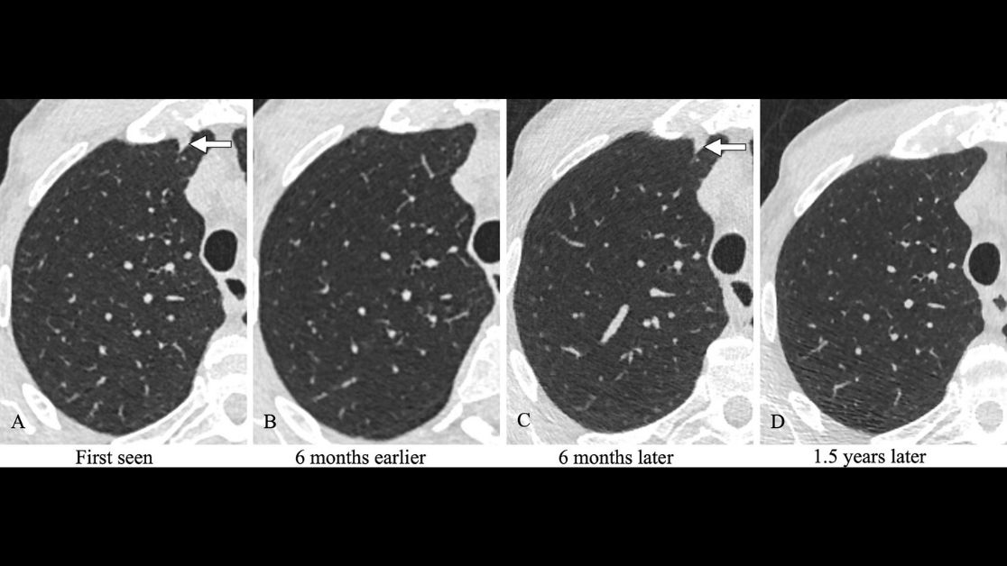 Newly detected solid costal pleura–attached noncalcified nodules at annual screening LDCT may not require immediate follow-up. bit.ly/2XpDE2R #LungScreening #I-ELCAP