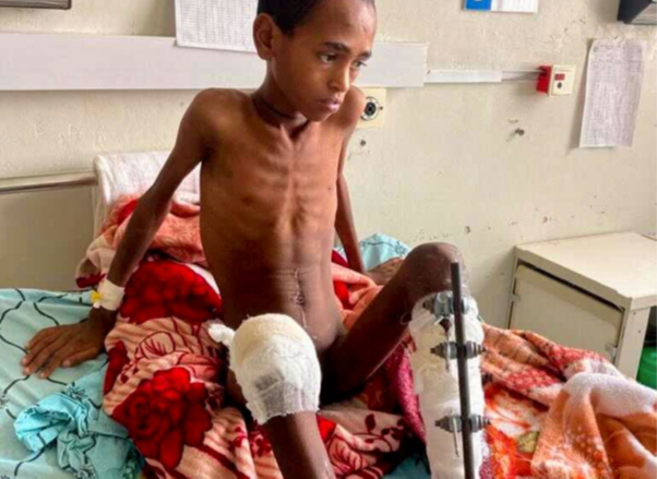 TghatMedia's tweet photo. Unique pictures show the conditions in the Peace Prize laureate’s country by @Aftenposten 

Pictures of famine from #Tigray 
See the English translation at  @emnet_negash's blog: https://t.co/oVBUIsaRMf

https://t.co/TVNa5HGVZF https://t.co/o0inrTGiKS