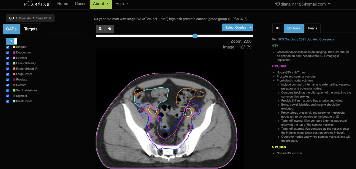 eContourRadOnc's tweet image. Another NEW 🔥 #radonc case from @baileynelson92 @uofcincy LIVE❗️ on #econtour 

✅ out this great intact prostate LN+ case ➡️  econtour.org/cases/138! #meded