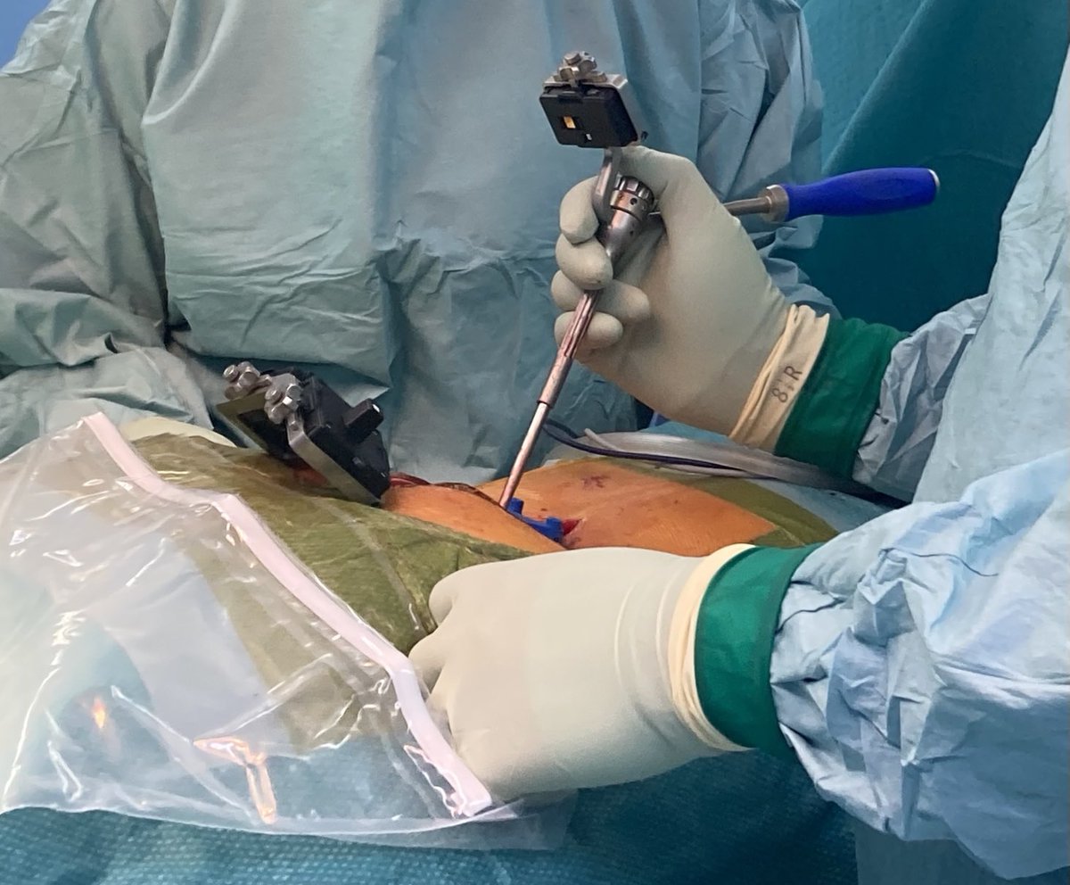 atmghn's tweet photo. Did my first spinal fusion with AugmentedReality/AR. It‘s really nice. Biggest difference is looking in the OR situs not to the monitor. https://t.co/wfYpAJWYHD