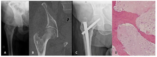 CurrentOncology's tweet photo. 🆕New Commentary by Daniel Axelrod, Aaron M. Gazendam and Michelle Ghert

The Surgical Management of Proximal Femoral #Metastases: A Narrative Review

🗨️"The proximal femur is a common location for the development of bony metastatic disease."
👉https://t.co/ojmxrDB2F8 https://t.co/oJAbXgwUoM