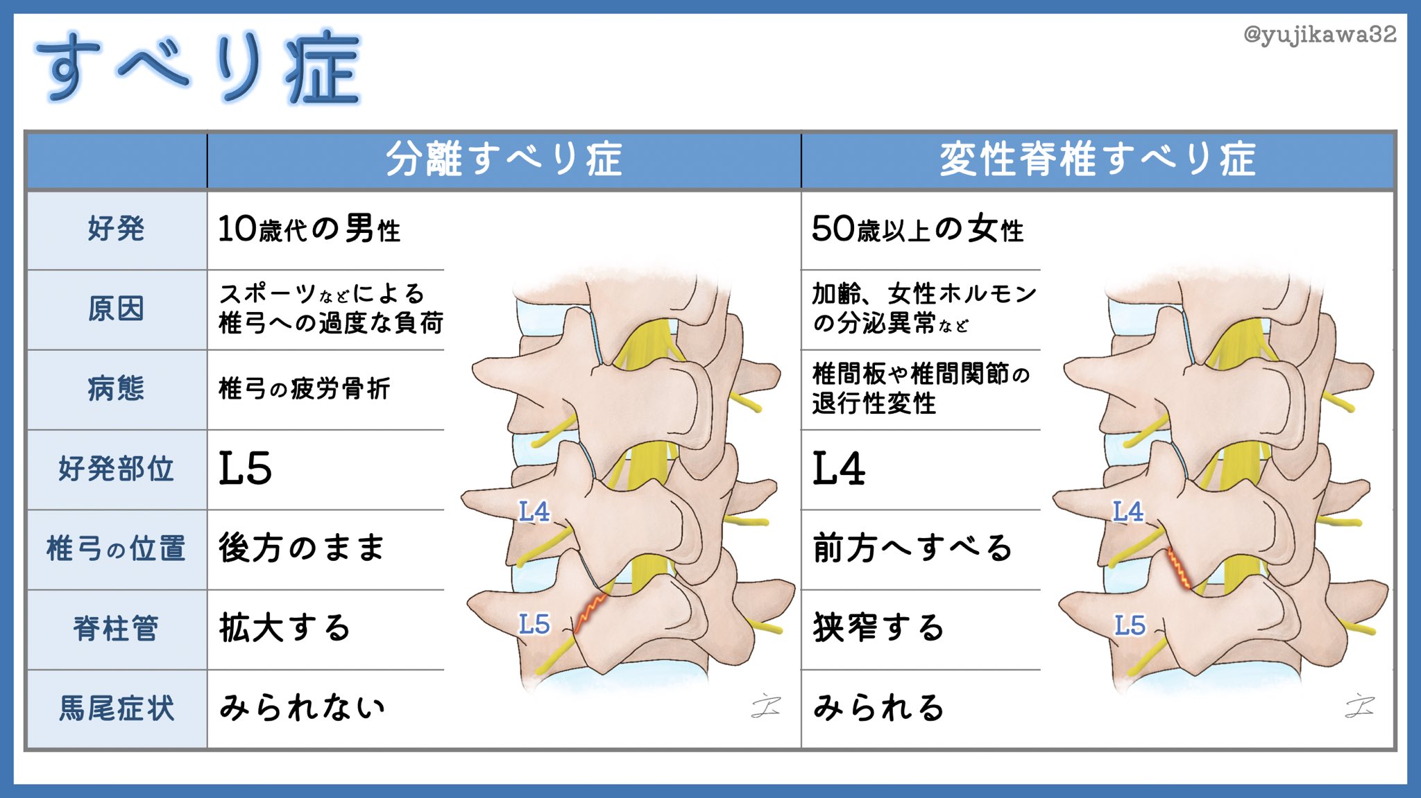 ユジカワ 整形dr イラストレーター 再投稿 これまでの脊椎疾患まとめです 椎間板ヘルニアと脊柱管狭窄症の 合併 という表現があるように それぞれは完全な別物 患者さんの中には高齢者でも 下肢の痺れ ヘルニアと思っている人が本当に多い