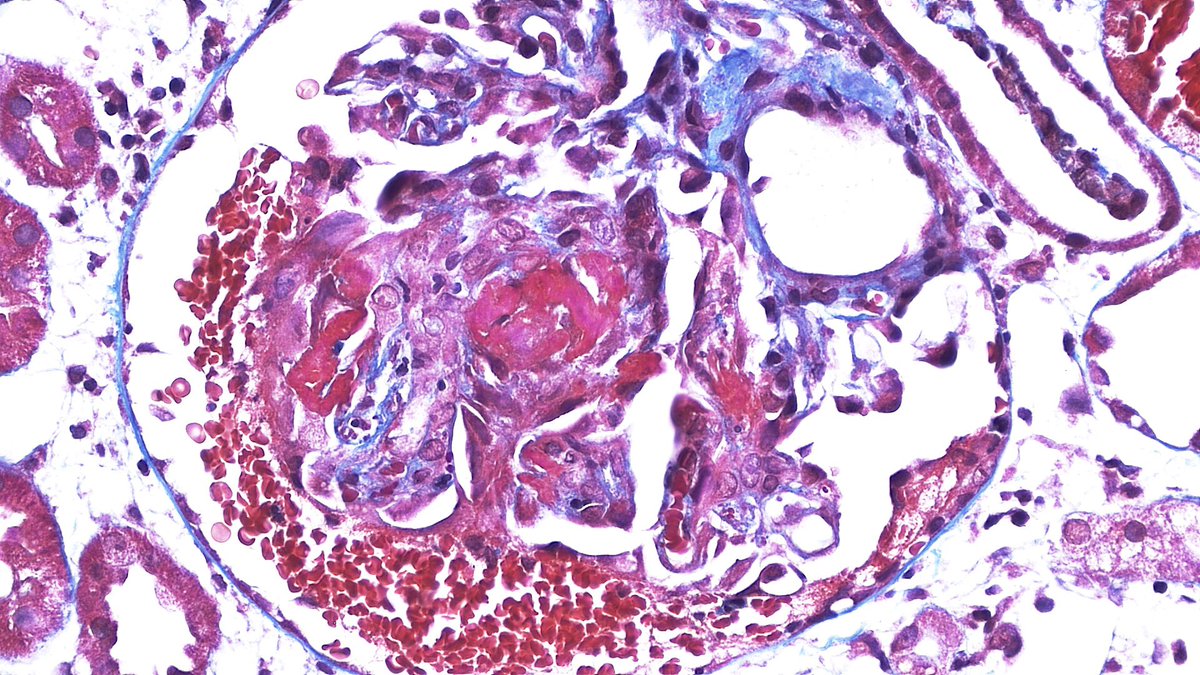 NephroPath's tweet photo. A crescent is born!!! Perfect example of crescent formation due to gbm rupture and fibrin deposition into Bowman’s space 🌜 #renalpath #pathology #nephrology #PicOfTheDay https://t.co/Sdt0hv01T5