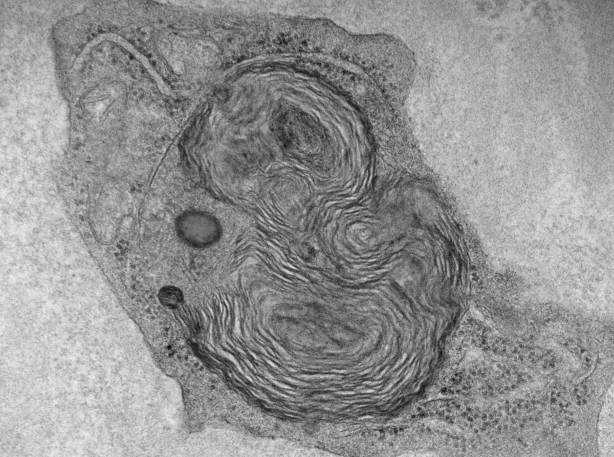 JeanHouMD's tweet photo. MBUO (Myeloid Bodies of Unknown Origin): 47 HF with malignant hypertension and acute renal failure. Bx with impressive vascular TMA changes and lots of these lipid inclusions ONLY in mesangial and endothelial cells (NOT in podocytes). No known drug/toxin exposure. 🤷‍♀️ @ldcornell https://t.co/FSjte8YpCO