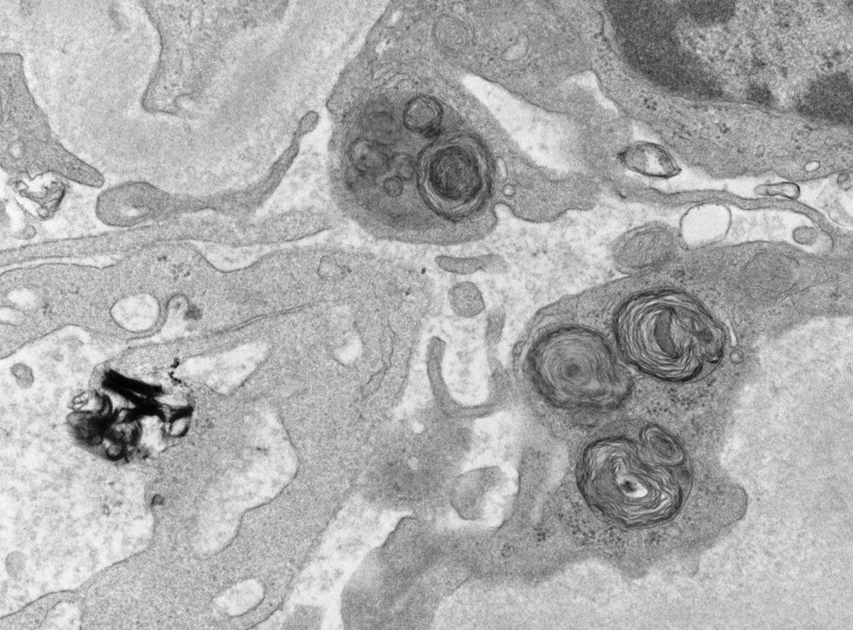 JeanHouMD's tweet photo. MBUO (Myeloid Bodies of Unknown Origin): 47 HF with malignant hypertension and acute renal failure. Bx with impressive vascular TMA changes and lots of these lipid inclusions ONLY in mesangial and endothelial cells (NOT in podocytes). No known drug/toxin exposure. 🤷‍♀️ @ldcornell https://t.co/FSjte8YpCO