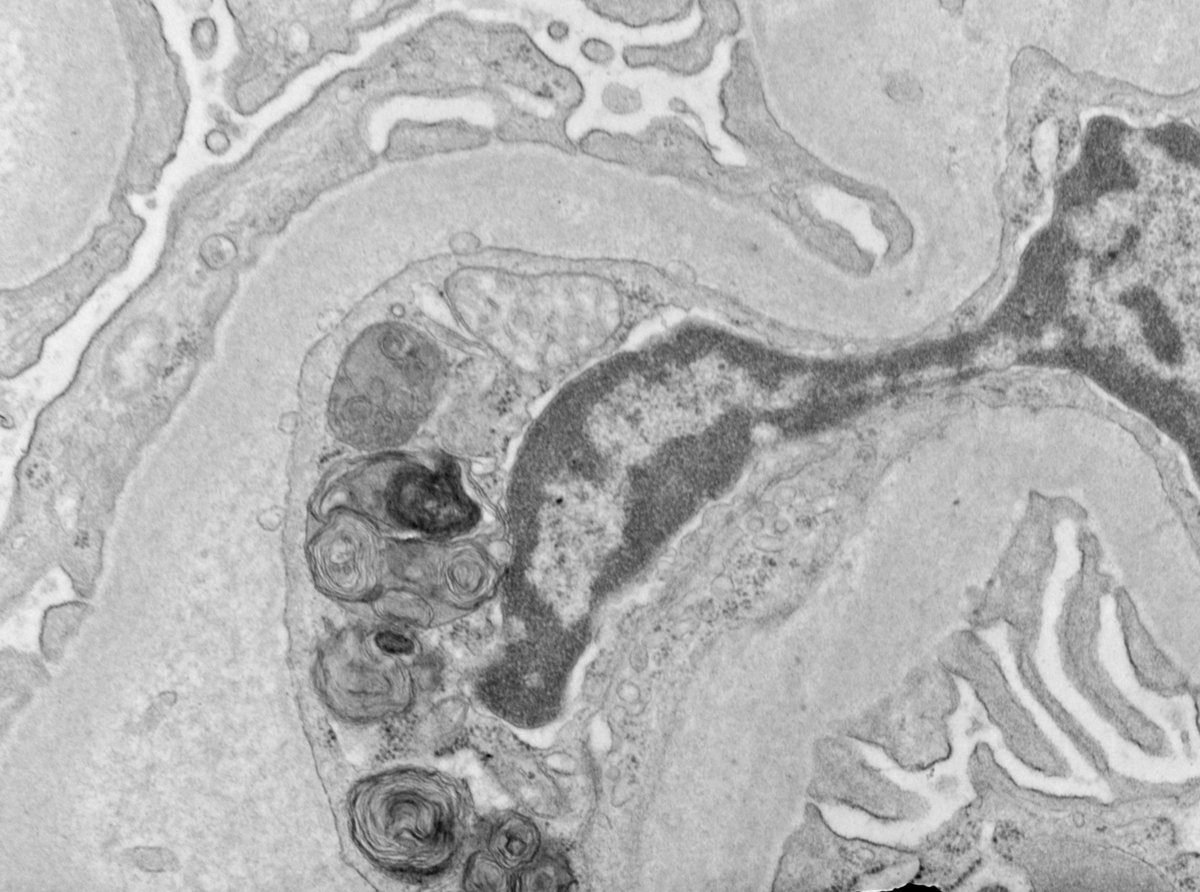 JeanHouMD's tweet photo. MBUO (Myeloid Bodies of Unknown Origin): 47 HF with malignant hypertension and acute renal failure. Bx with impressive vascular TMA changes and lots of these lipid inclusions ONLY in mesangial and endothelial cells (NOT in podocytes). No known drug/toxin exposure. 🤷‍♀️ @ldcornell https://t.co/FSjte8YpCO