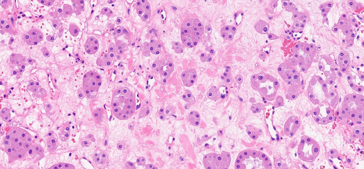 #GUpath: nephrectomy with classic "archipelago" (group of islands) pattern of renal oncocytoma

#LPpath Dx at its best!