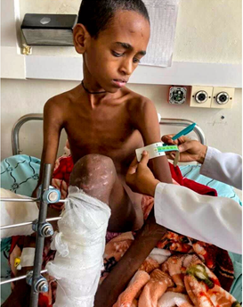 berhetes1's tweet photo. This photo of a malnourished 10 year old was taken on 9/22/2021. The child is one of many children admitted to Ayder Hospital for malnutrition. In just a few weeks, they will be out of emergency food. Please help #StopTigrayFamine. @HouseForeign @hrw https://t.co/n87RbBsca6