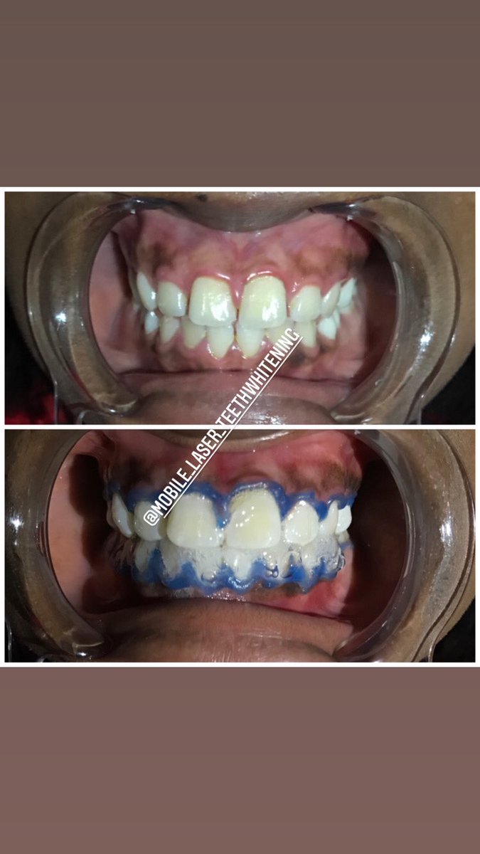 PremierTeeth's tweet photo. https://t.co/zMR56O1Oxk