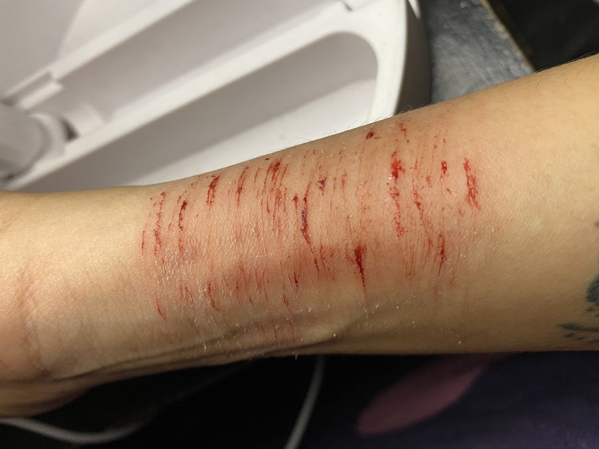 giselgege's tweet photo. When bipolar relapse and suddenly want to share how beautiful these scar https://t.co/kOGBmM6Vy6