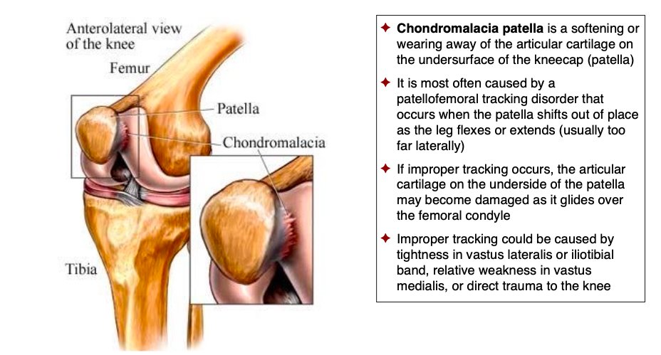 AnatomyStudies's tweet photo. Spotlight on a common knee injury

#anatomystudiesforyogateachers #anatomystudies #anatomyforyogateachers #asfyt2021 #asfyt #yogaanatomy #functionalanatomy #commonyogainjuries #biomechanicsofyoga #kinesiologyofyoga #teachtolearn #learntoteach #yogaishappiness #yogateacher https://t.co/1OBLVLZSHc