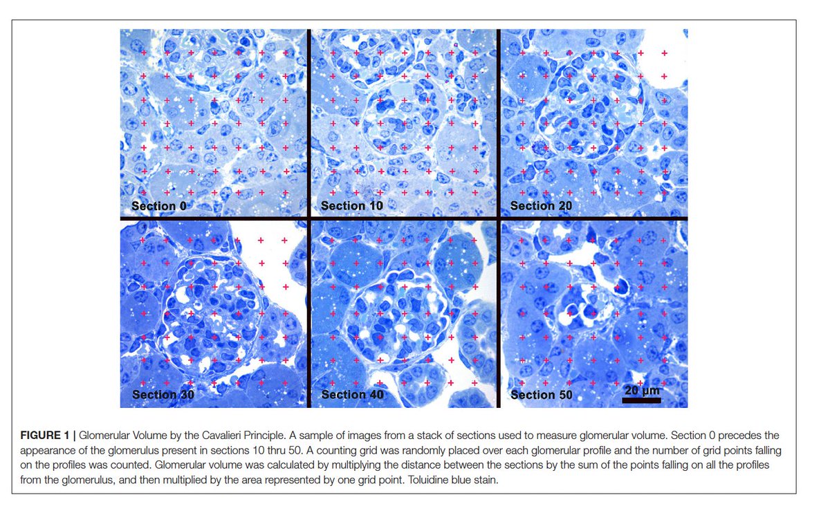 ISMMSKidney's tweet photo. "#Podocyte Foot Process Effacement Precedes Albuminuria &amp; Glomerular Hypertrophy in
CD2-Associated Protein (CD2AP) Deficient 🐭"

https://t.co/Axu46NywgR

@kirkcampbell @JustinaLRay @FrontiersIn @DOMSinaiNYC https://t.co/QnIbfVbKbN