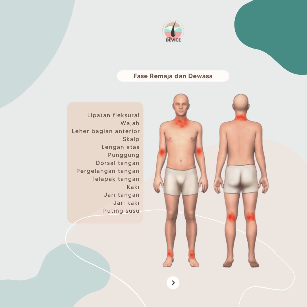 device_fkui's tweet photo. Tentunya, fase pertumbuhan kita sampai ke masa remaja dan dewasa. Bagaimana dermatitis atopik muncul pada masa remaja dan dewasa🤔? Mari kita lihat bersama di bawah ini https://t.co/i4KkzkyNv1