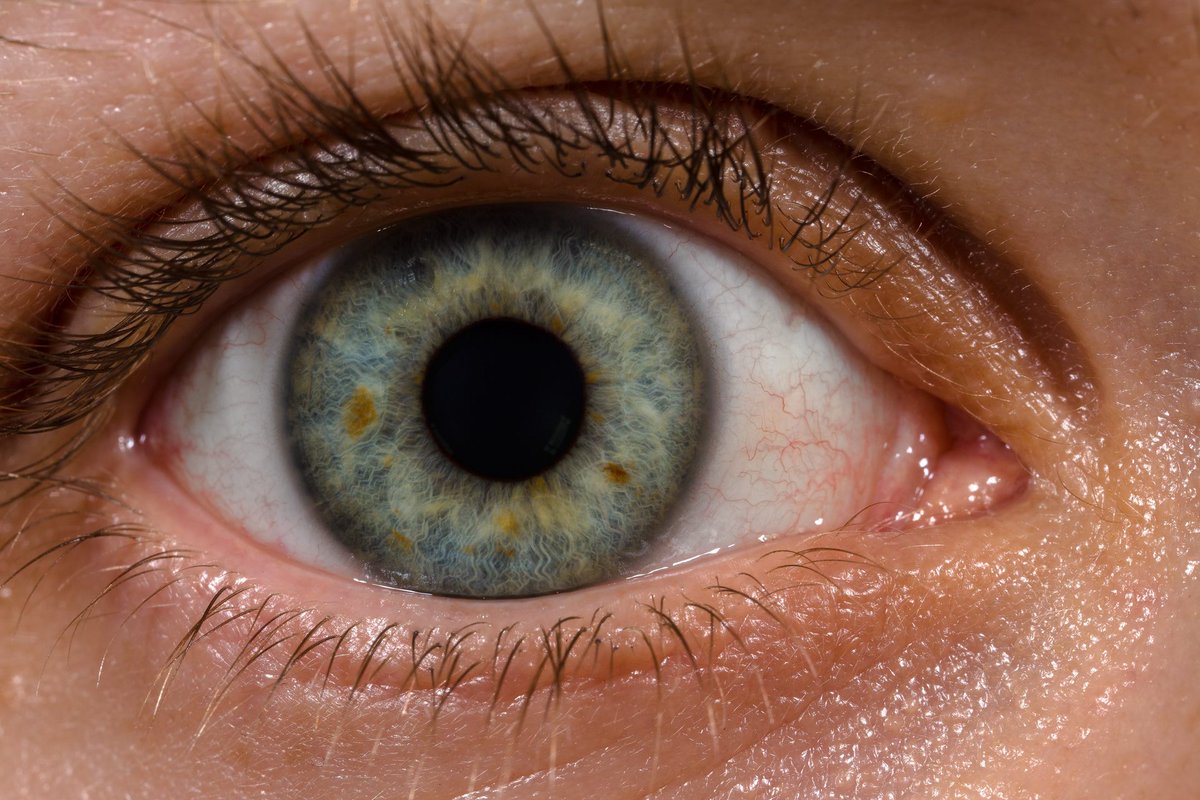 Kiran Musunuru (@kiranmusunuru) on Twitter photo Another step towards therapeutic in vivo gene editing:
Treatment of patients with Leber congenital amaurosis type 10 (LCA10), announced by Dr. Mark Pennesi <a href="/CaseyEye/">OHSU Casey Eye</a> and <a href="/editasmed/">Editas Medicine</a> today.
Here’s the background & overview of the new results.
(thread)
x.com/kiranmusunuru/… Another step towards therapeutic in vivo gene editing:
Treatment of patients with Leber congenital amaurosis type 10 (LCA10), announced by Dr. Mark Pennesi <a href="/CaseyEye/">OHSU Casey Eye</a> and <a href="/editasmed/">Editas Medicine</a> today.
Here’s the background & overview of the new results.
(thread)
x.com/kiranmusunuru/…