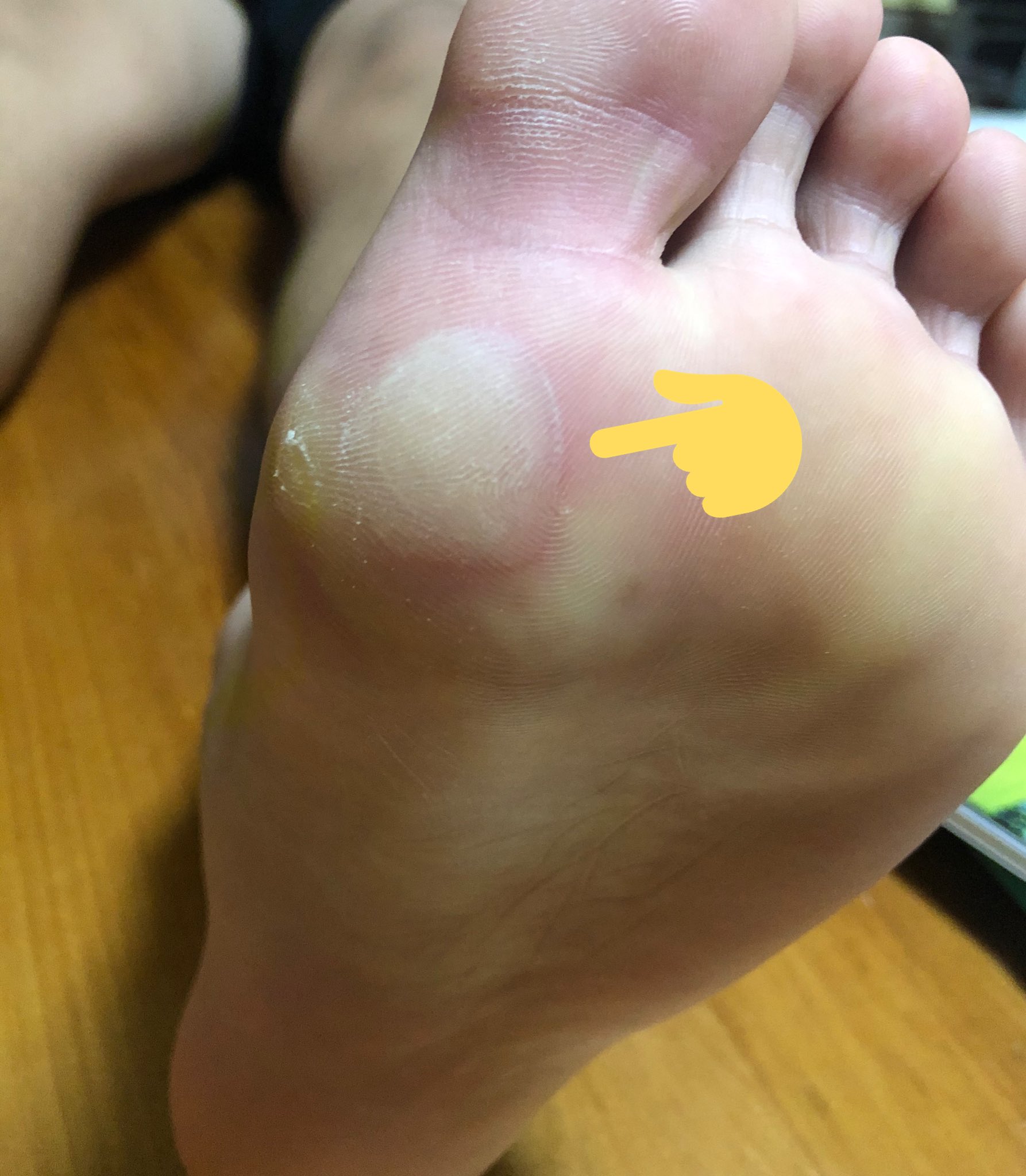 Aozora 13歳息子 卓球しすぎで力がかかったのか 足裏にタコできてたしまたタコかと思ったが 触ったらプニプニするし 水ぶくれみたいで あすは大会だし明日は医者いけませんがこれ どうしたら良いか分かる方いますか 田舎で皮膚科も近くになく明日は行け