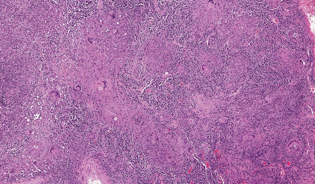 daoud_elena's tweet photo. Brain of an immunocompromised patient. What do you think this is? https://t.co/TqbC75erld
