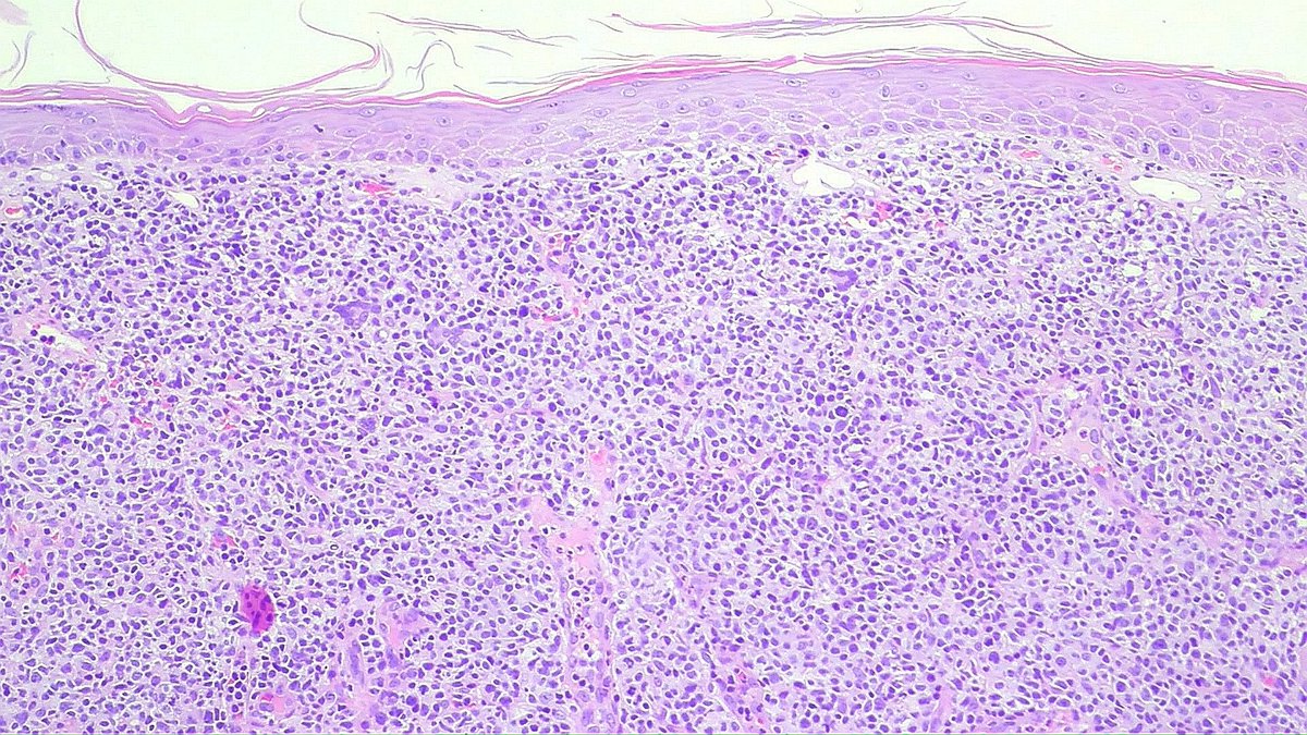 DraGarmar's tweet photo. 77 yo, female. Multiple skin lesions
IHQ: CD3+, CD5+, CD4+, CD30(focal), CD7-. Ki67 40%.
.
.
.
.
-Advanced mycosis fungoides without epidermotropism.
#dermatopathology #dermatopath https://t.co/Va3zqKZQjY