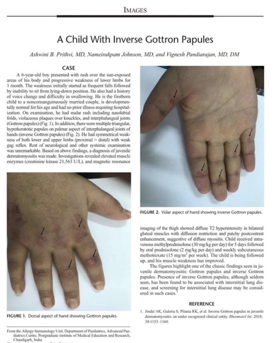 LatikaGupta_'s tweet photo. A Child With Inverse Gottron Papules https://t.co/WJUxwq4LdY
@vignesh_pgi @JRheumatology https://t.co/MB3W3ntOPL