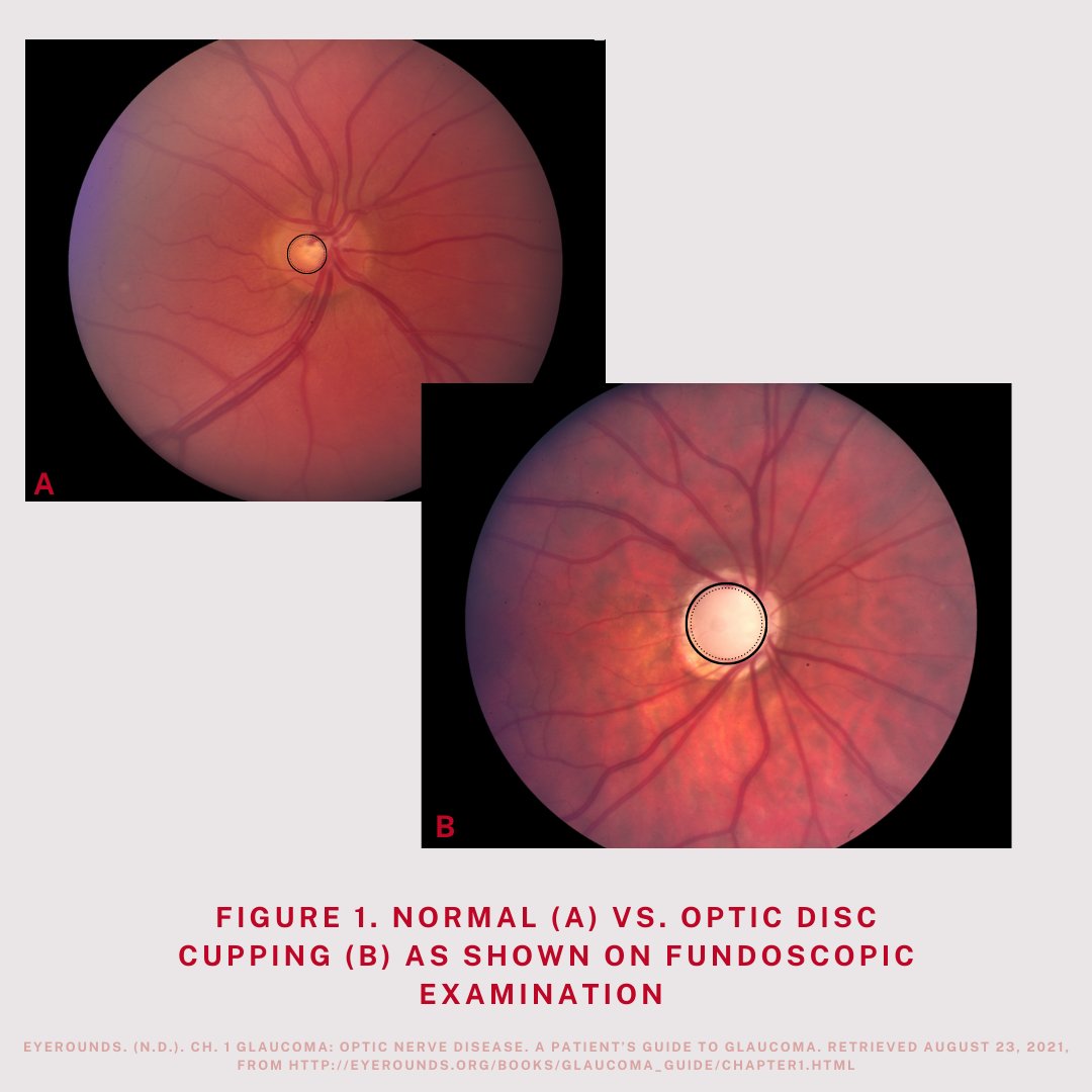 EyeCurriculum's tweet image. Need a quick refresher on Open-Angle Glaucoma? Here is a pocket-note version! Open-Angle glaucoma is the most common form of the disease in North America. #Fundoscopy #Glaucoma #OpenAngle