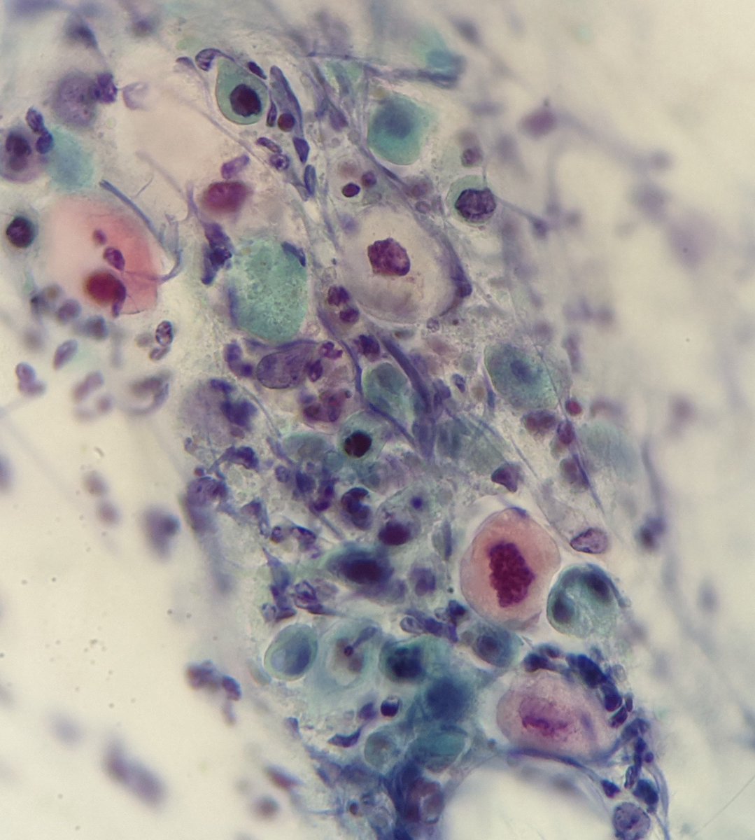 PSzwebel's tweet photo. Conventional PAP smears
HSIL ENDOGLANDULAR INVOLVMENT
Oval shape like a tubular structure fullfill by smal cells with increased nucleus cytoplasm ratio
Irregular nuclear membrane
Some nucleoli and detritus advise for posible invasion. 
#citology 
#gynpath 
#citopath https://t.co/rdfCx9Ojhy