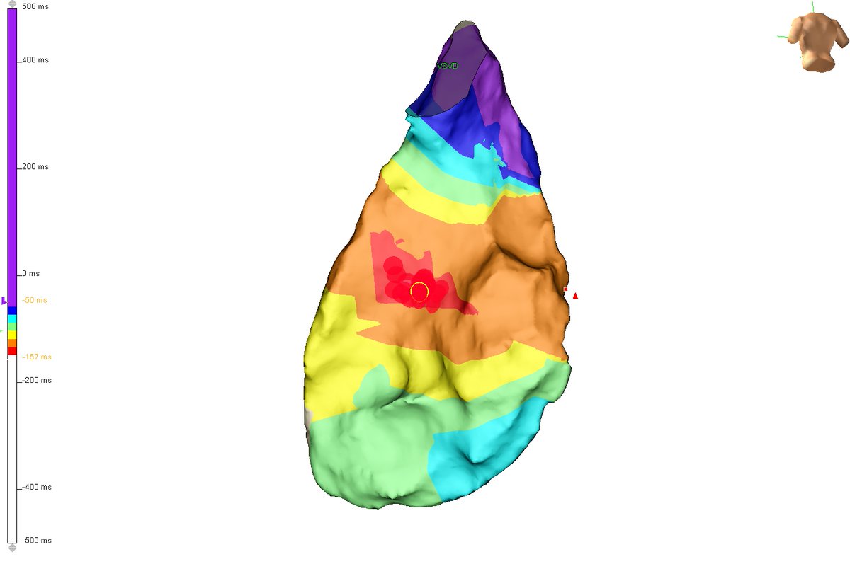 Gabriel05891017's tweet photo. Ablating right posterior ventricular premature complexes... So good when pacing mapping e activation map are  concordants #Epeeps #electrophysiology #cardiology  #arrhythmia #EP https://t.co/ZFcAc5WPR4
