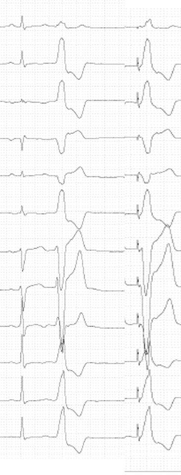 Gabriel05891017's tweet photo. Ablating right posterior ventricular premature complexes... So good when pacing mapping e activation map are  concordants #Epeeps #electrophysiology #cardiology  #arrhythmia #EP https://t.co/ZFcAc5WPR4
