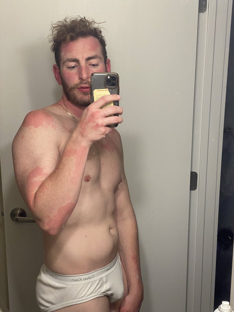 pale_caesar's tweet photo. it’s just a birthday rash it’s okay https://t.co/cYHhwQVPjt