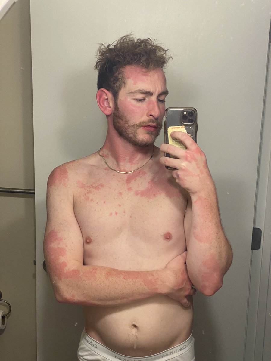 pale_caesar's tweet photo. it’s just a birthday rash it’s okay https://t.co/cYHhwQVPjt